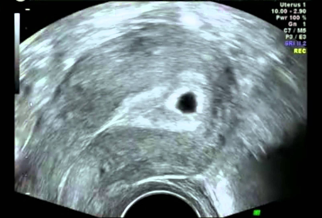 Плодное яйцо на УЗИ 3-4 недели беременности