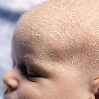Корочки себорейного дерматита на голове  младенца