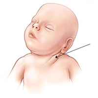 Уплотнение на шее младенца при кривошее