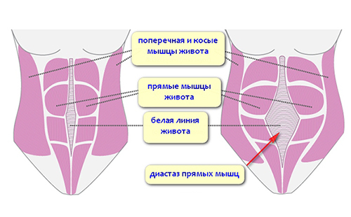 На рисунке диастаз прямых мышц живота (справа)