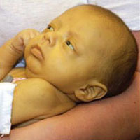 Новорожденный пожелтел от билирубина