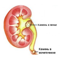 Камни в почке и в мочеточнике