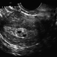 Ультразвук покажет эмбрион