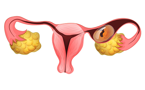 Графическое изображение внематочной беременности