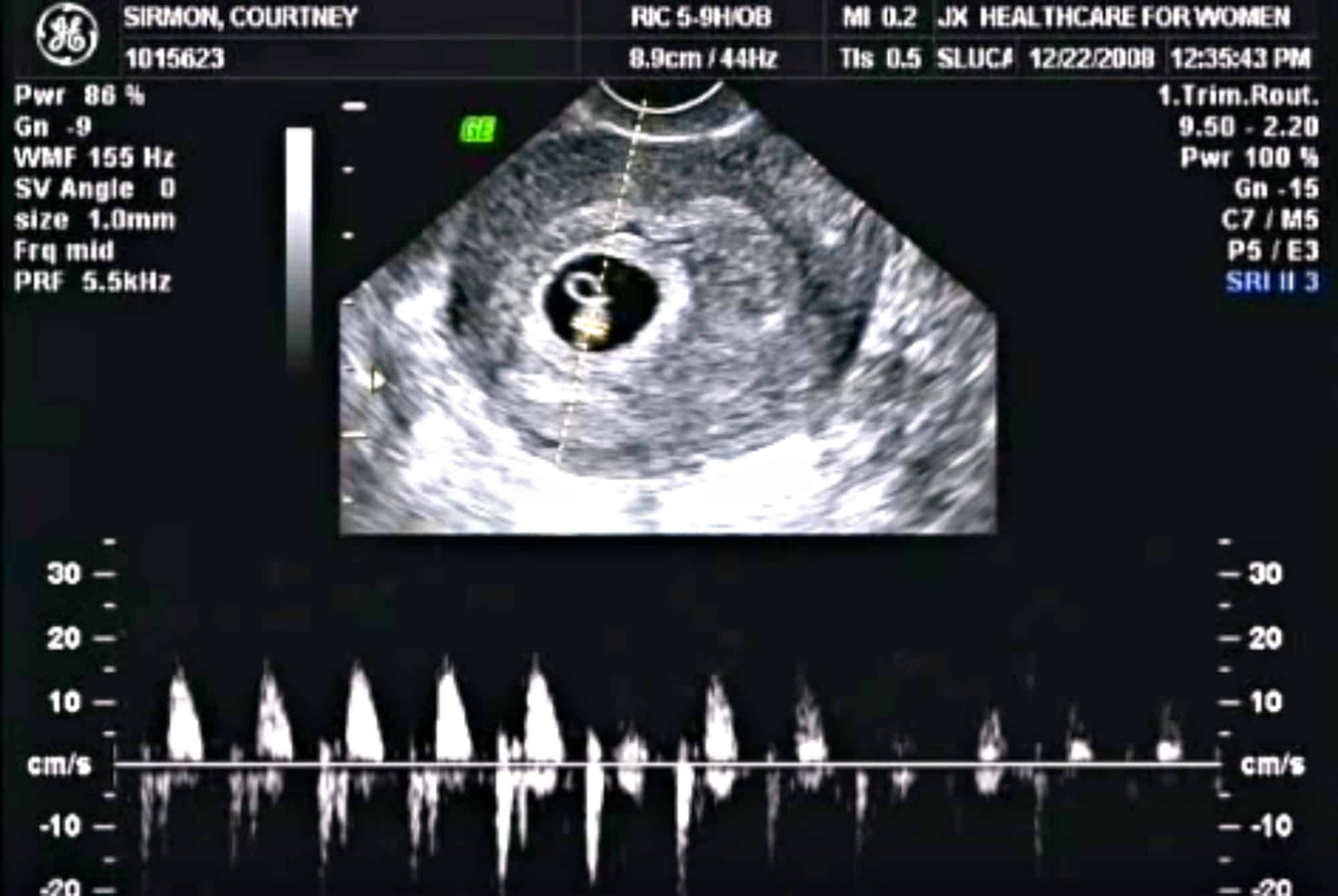Сколько по времени делают узи. 5 Недель беременности размер эмбриона на УЗИ. 5 Недель беременности размер плода УЗИ. Размер плода на 5 неделе беременности по УЗИ. Беременность 6 недель размер плода на УЗИ.