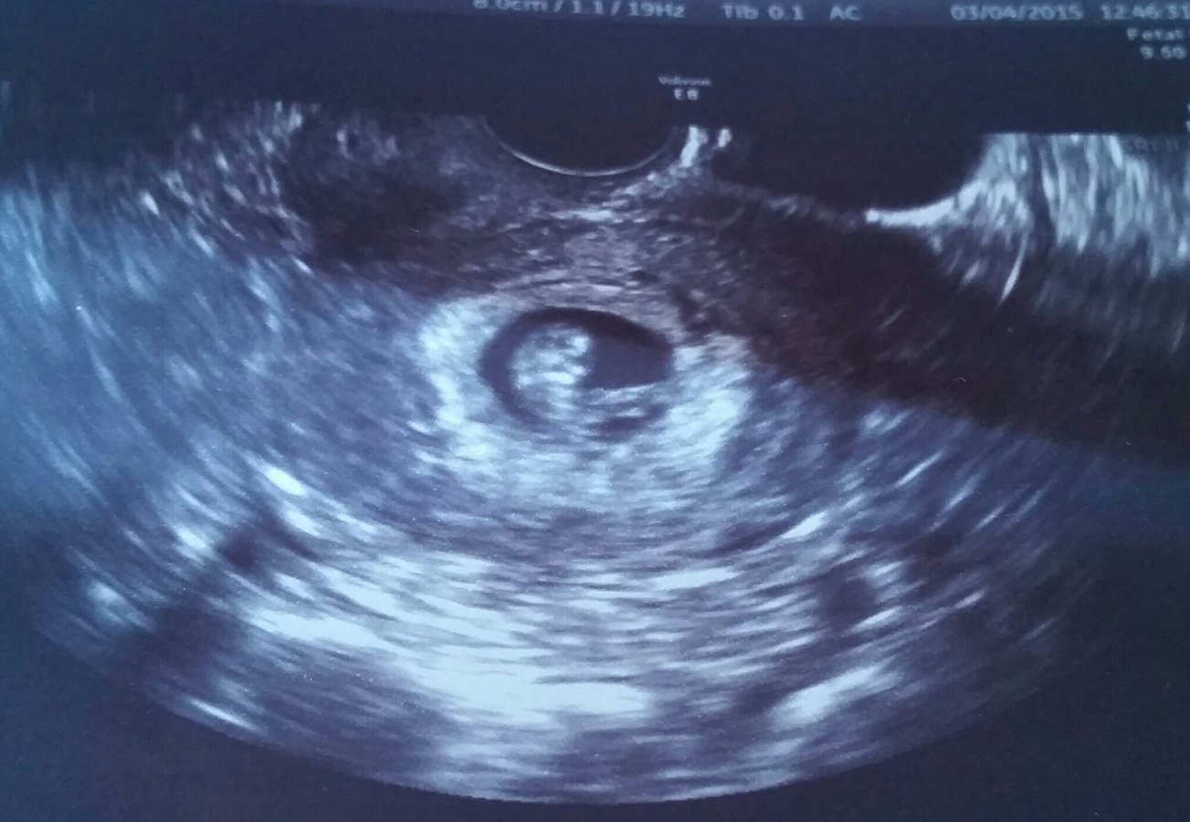 6 недель изменения. Эмбрион на 7 неделе беременности УЗИ. УЗИ на 7 акушерской неделе беременности. УЗИ ребенка на 7 неделе беременности. Эмбрион 7 недель УЗИ.