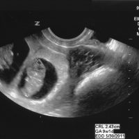Девятинедельный эмбрион на снимке УЗИ